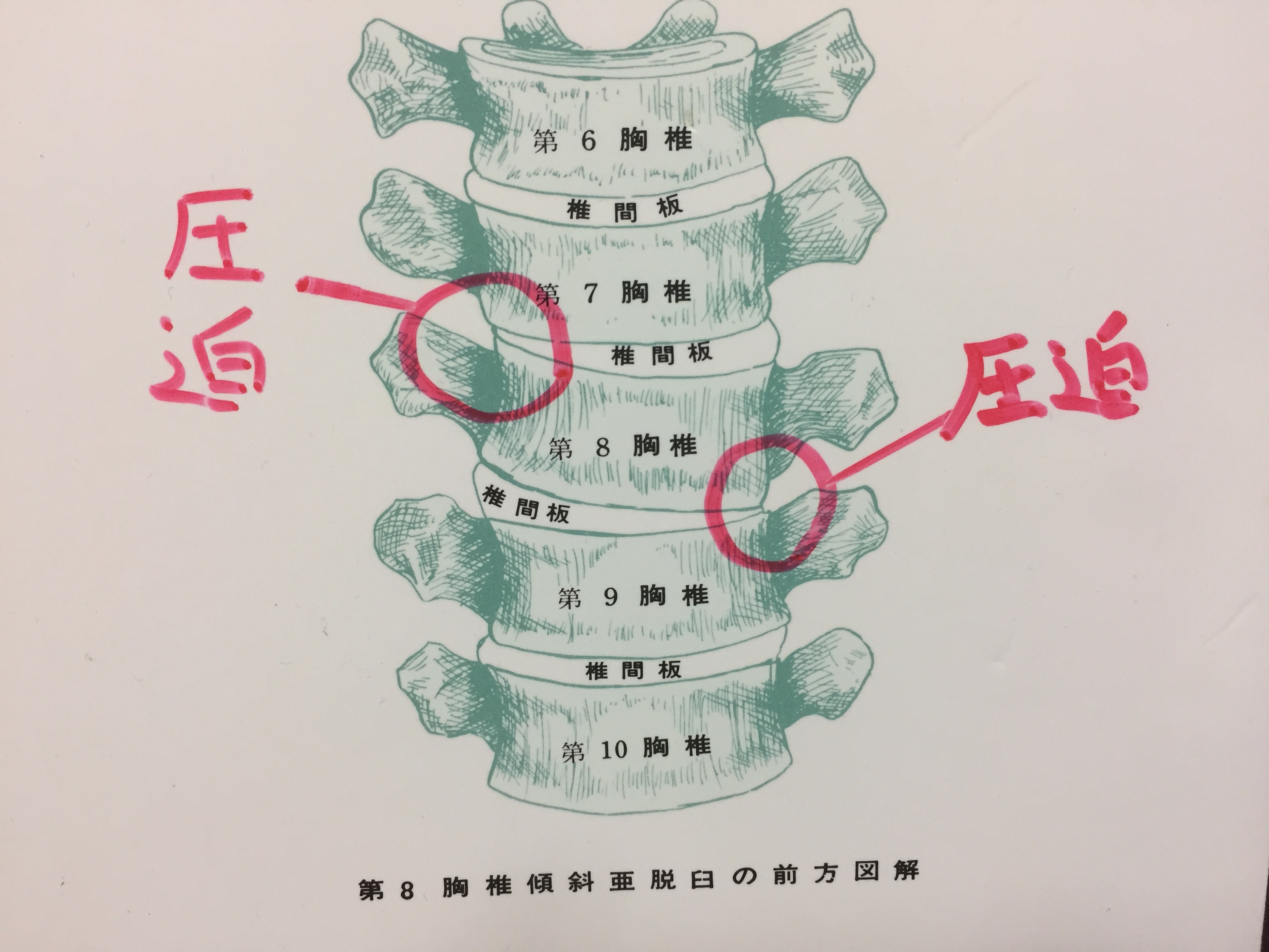 亜脱臼.jpg